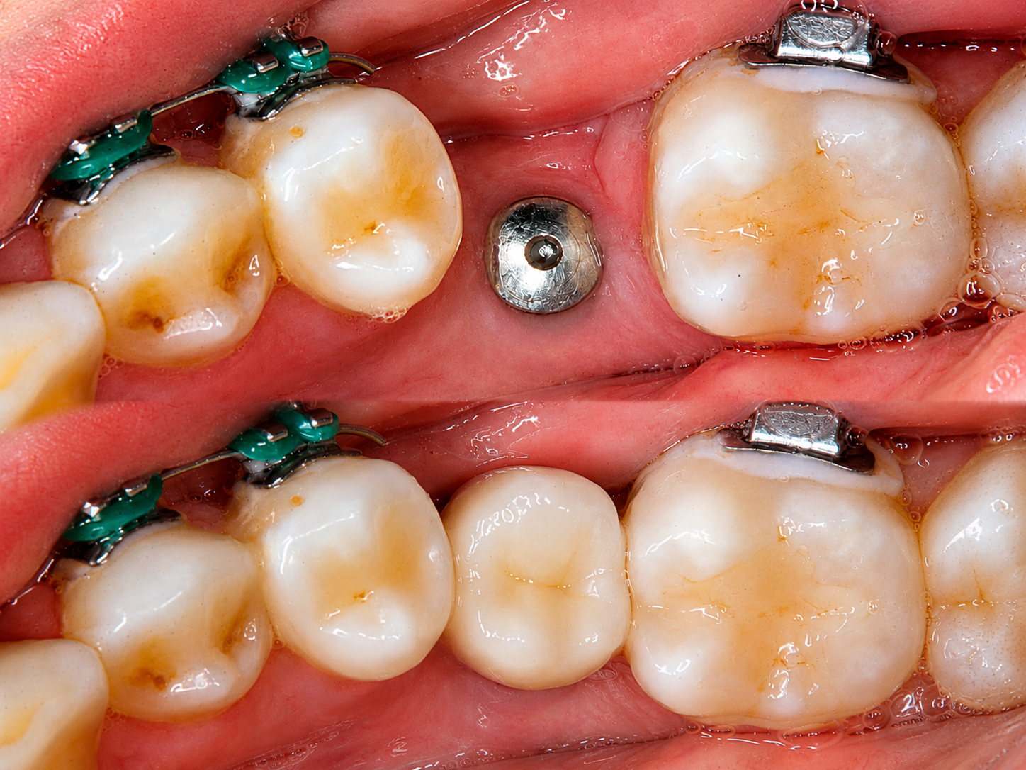 Implantes Dentários